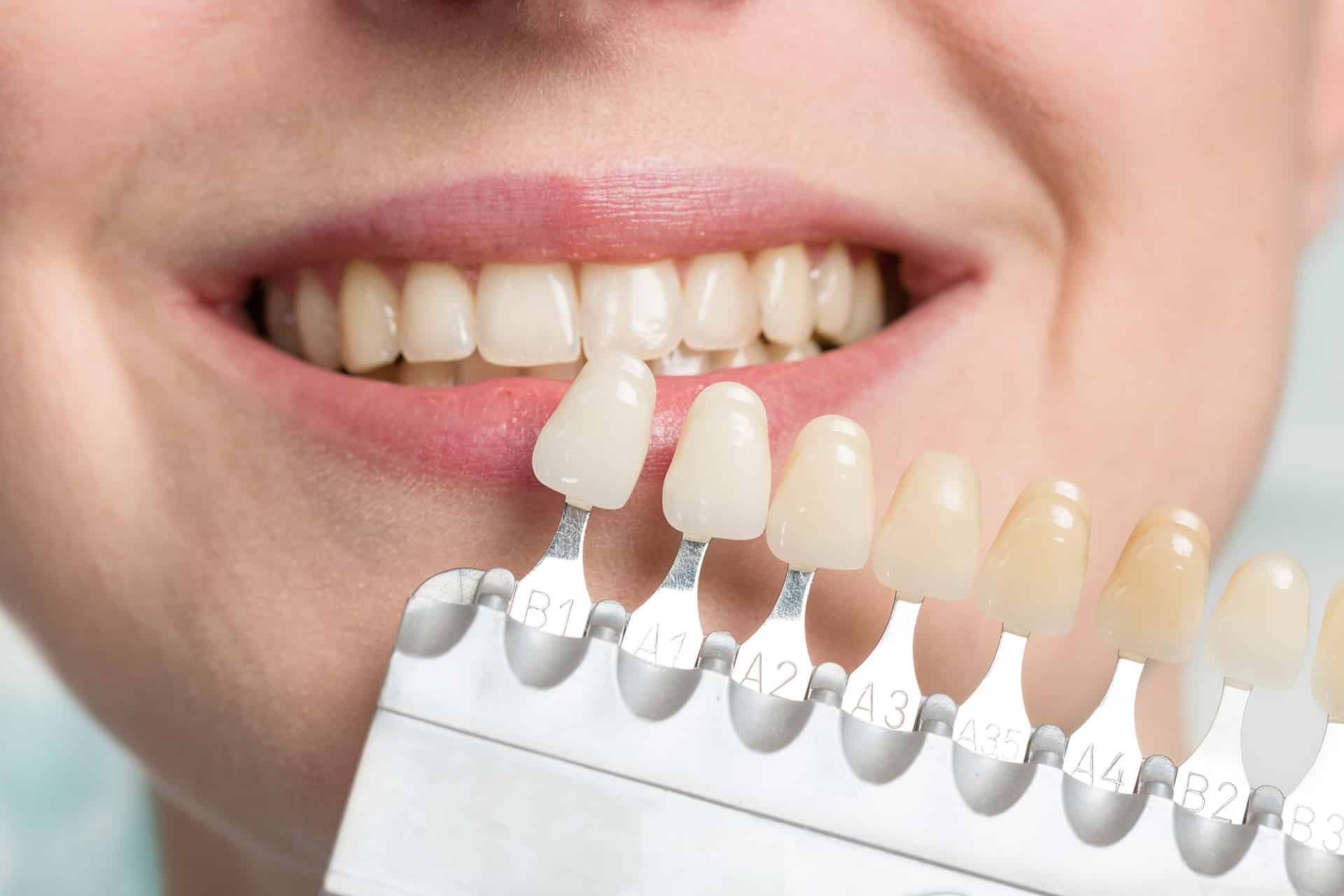 porcelain veneers at Serenity Creek Dental