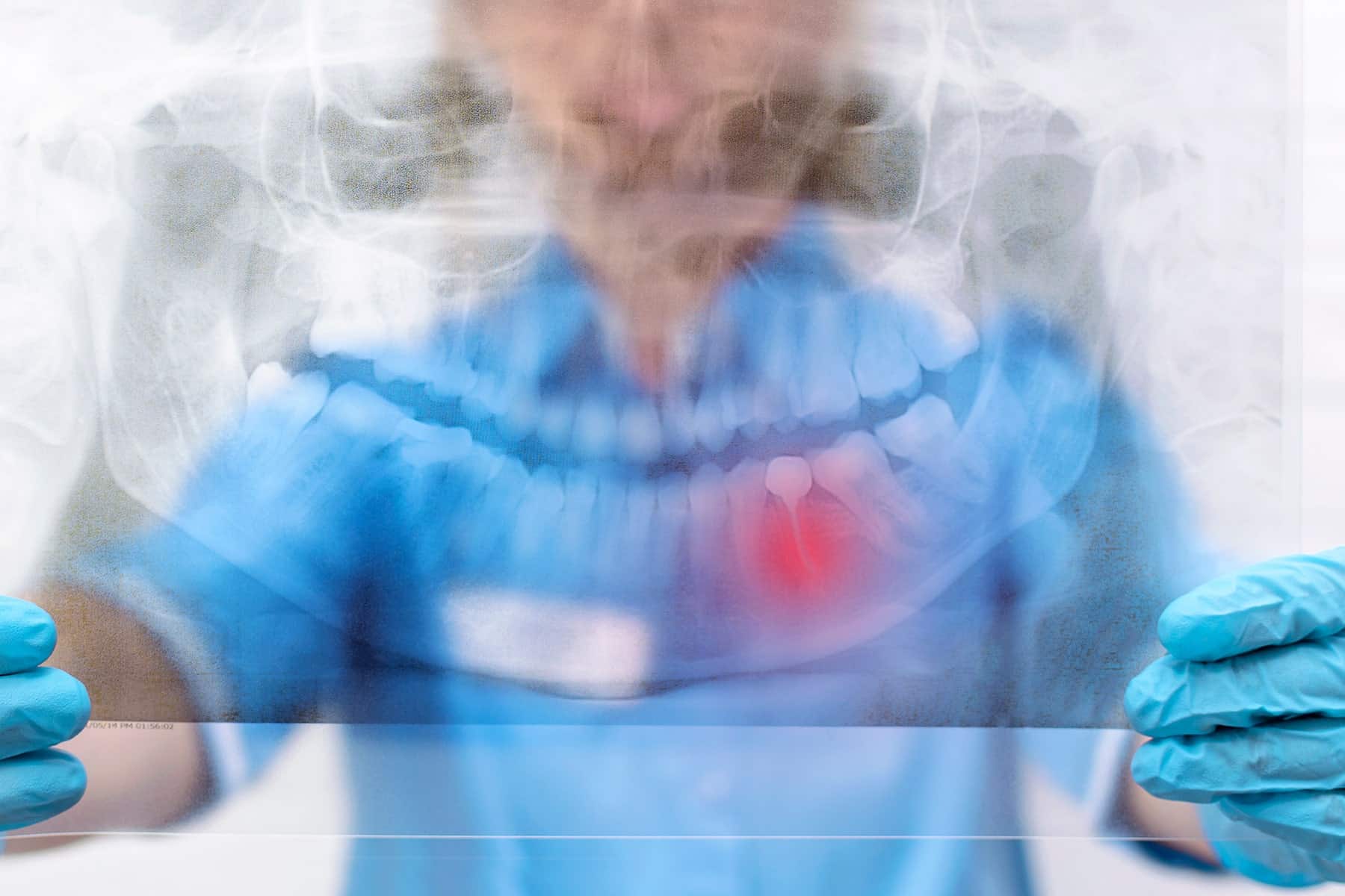 Root canal dentist in Noblesville, IN