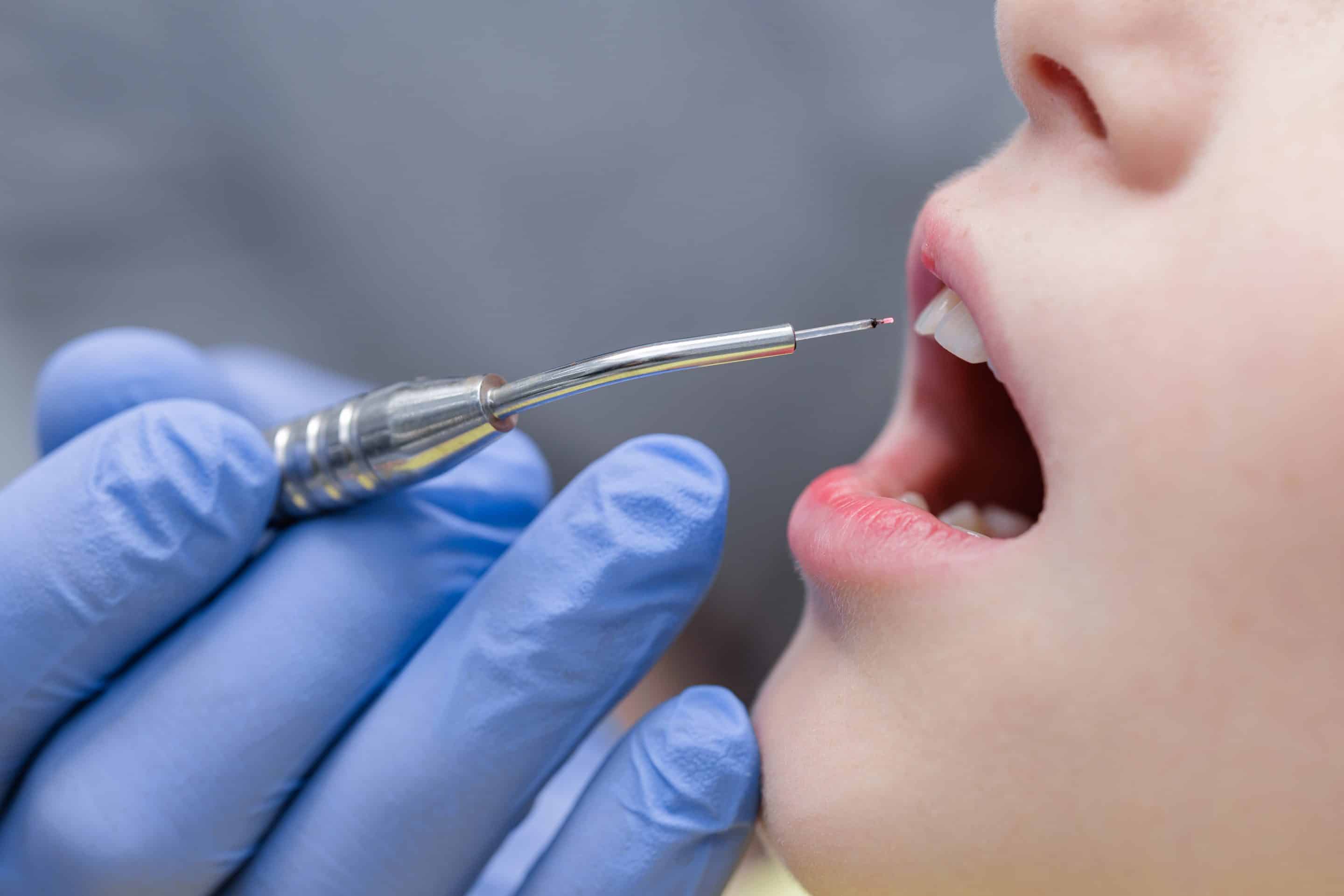 Dental laser treatments in Noblesville, IN